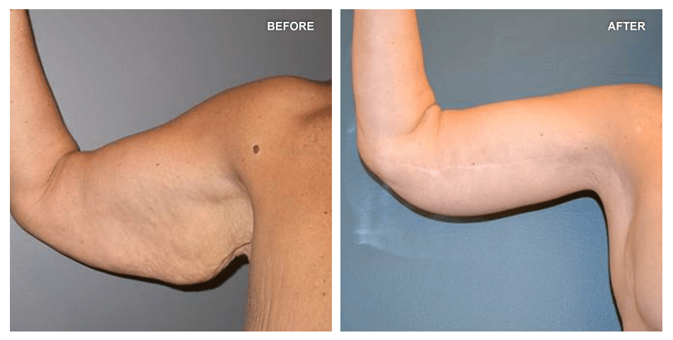 Brachioplasty, female, age 51, 3 years after surgery by J. Peter Rubin, MD